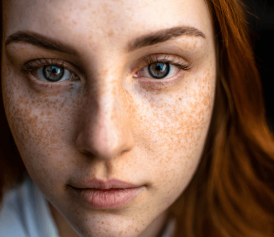 Best Proven Treatments to Get Rid of Dark Spots Get rid of Dark Spots