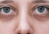 How to Treat Under-Eye Dark Circles (Home Remedies) treat under-eye dark circles