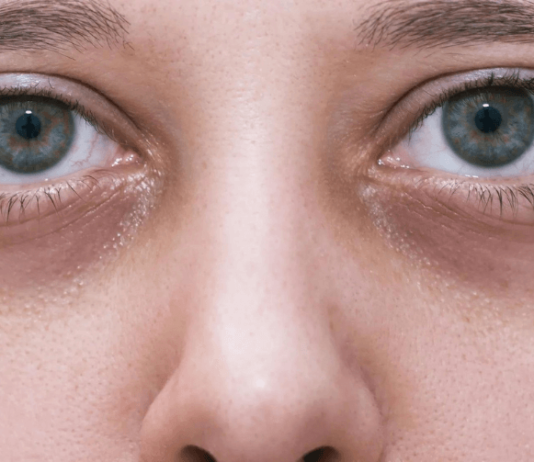 How to Treat Under-Eye Dark Circles (Home Remedies) treat under-eye dark circles