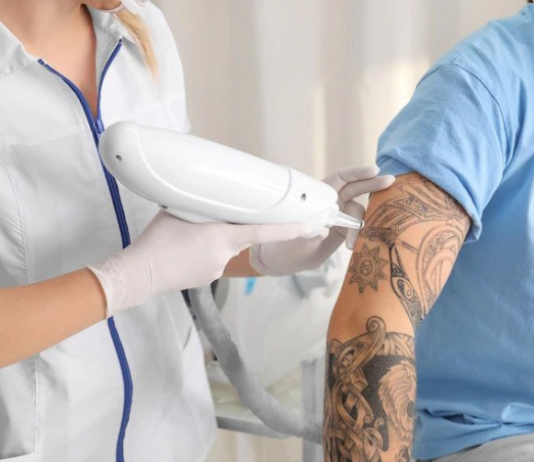 Tattoo Removal: Things You Must Know Before Getting It things to know before tattoo removal